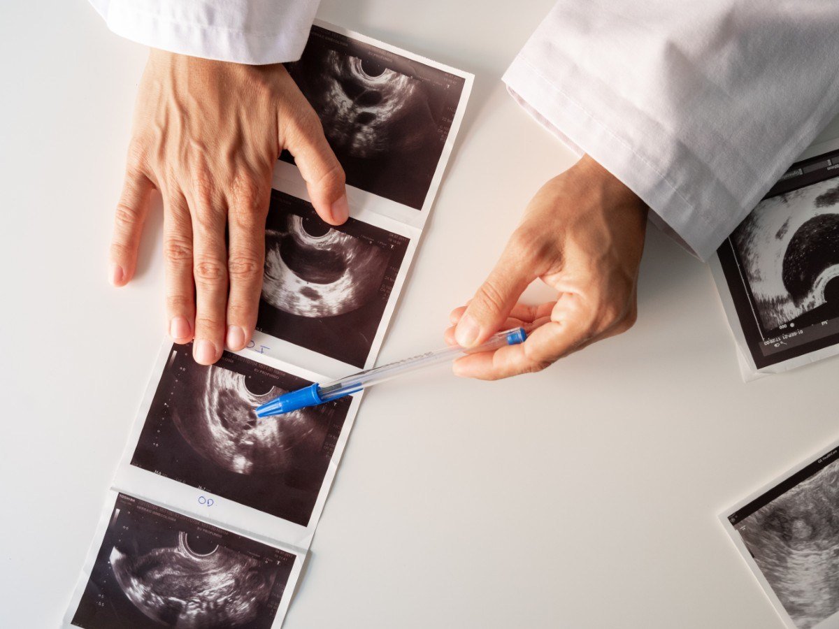 Nuovi studi esaminano possibili collegamenti tra PMOS e demenza